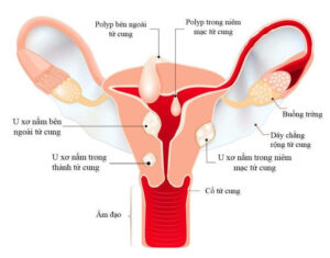 U xơ tử cung là gì?