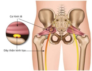 Hội chứng cột sống lề